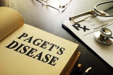 Doença de Paget: tudo o que você precisa saber    