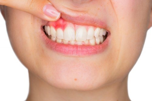 Ir ao dentista evitará gengivite