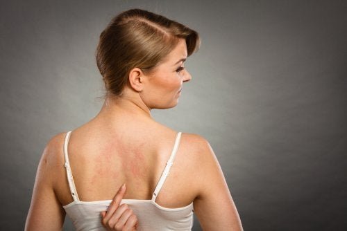 Mulher com alergia alimentar