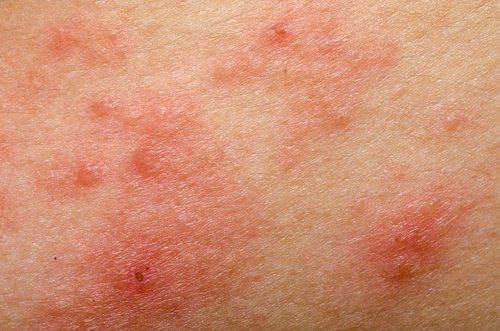 Sinal da dermatite na pele