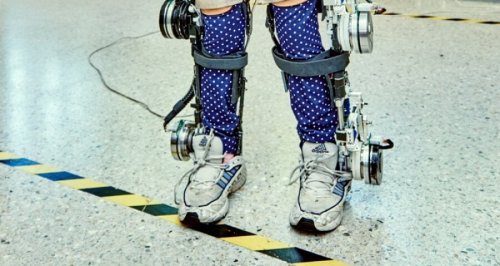 Menina com displásia óssea