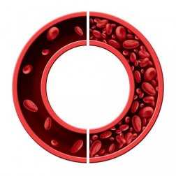 Tratar a anemia ferropênica com 5 remédios naturais