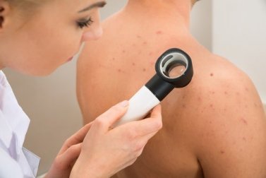Por que você tem acne nas costas?