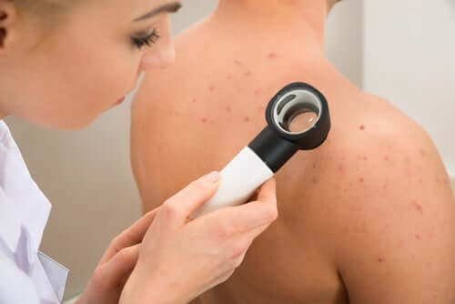 Por que você tem acne nas costas?