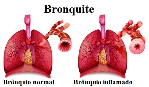 Brionquite pode dar tosse