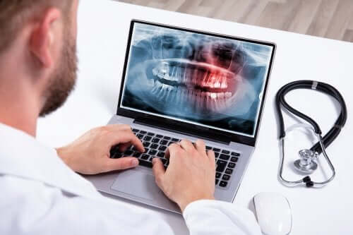 Hiperdontia: causas e tratamento