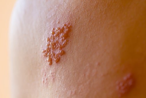 Lesão de herpes