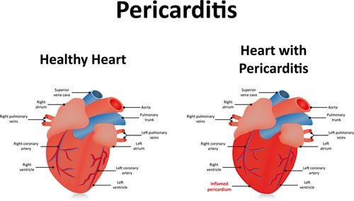 Coração saudável e com pericardite