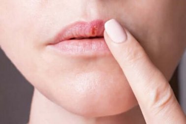 Tipos de herpes