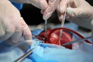 Coração artificial que promete ajudar aqueles que não têm doador