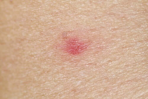 Alergia a picada de mosquito