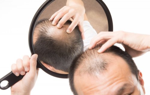 A alopecia androgenética é um dos motivos da queda de cabelo