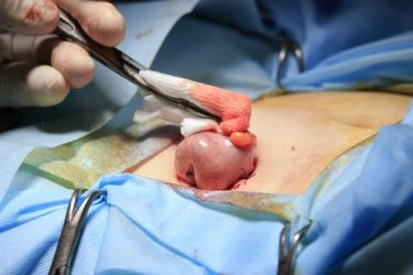 Colostomia, em que consiste?
