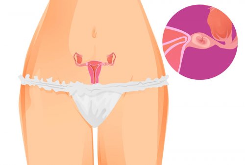 Evolução da gravidez ectópica