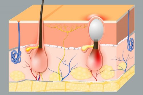 Fisiologia do folículo piloso e furúnculos vaginais