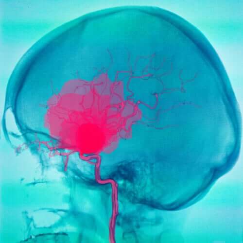 Hemorragia cerebral