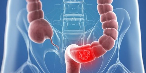 Intestino grosso e colostomia