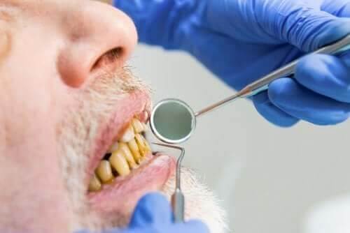 Prejuízos do tabaco na cavidade oral