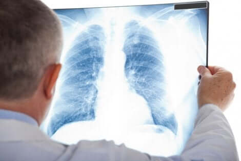 Radiografia de pulmão para diagnóstico