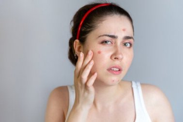 Tratamentos para a acne