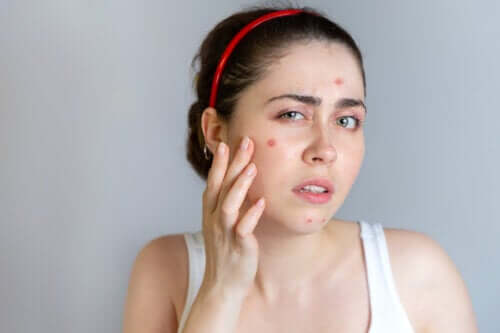 Tratamentos para a acne