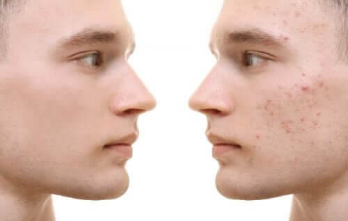 Cúrcuma para a acne: benefícios e modo de uso
