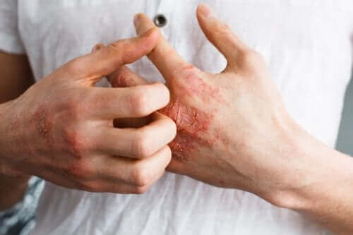 No eczema, ocorre uma descamação da pele