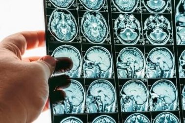 Herniação ou conificação cerebral