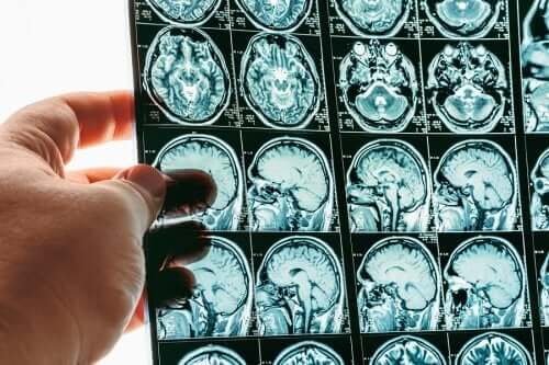Herniação ou conificação cerebral
