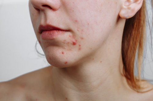 Mulher com acne no rosto