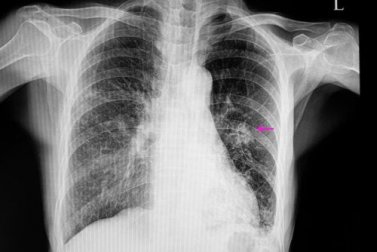 Nódulo pulmonar, o que isso significa?