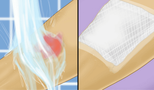 Em caso de queimaduras em crianças, lave a queimadura com água e aplique gaze