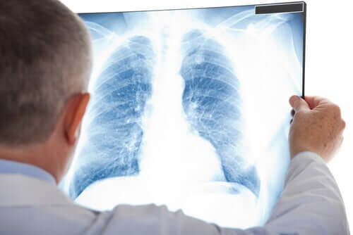 Um nódulo pulmonar pode ser indício de muitas doenças