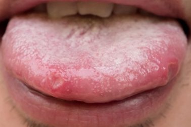 Candidíase oral: alternativas naturais