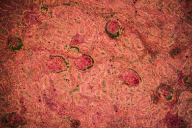 Tuberculose renal: diagnóstico e tratamento