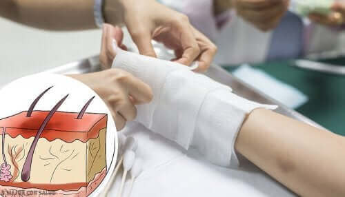 Queimaduras em crianças: braço envolto em chiffon