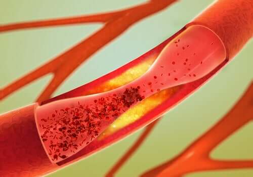 Foco do acidente vascular cerebral