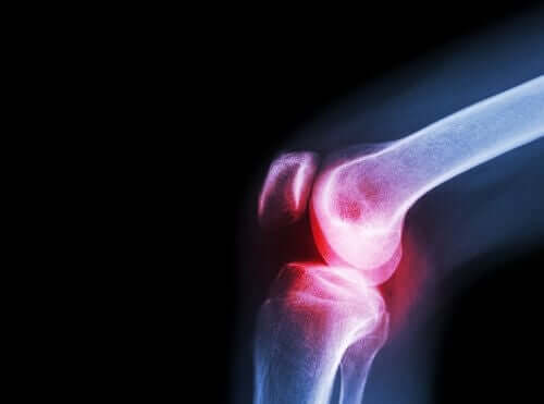 Artrite no joelho