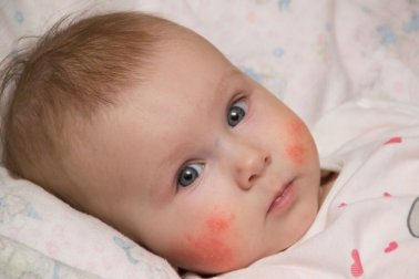 5 tipos de irritações comuns da pele do bebê