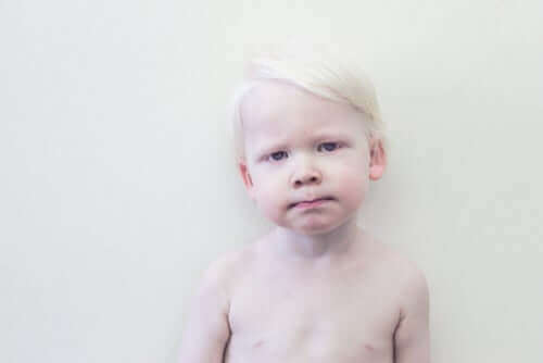 Criança albina