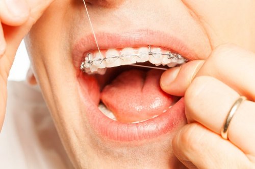 Passar fio dental com aparelho