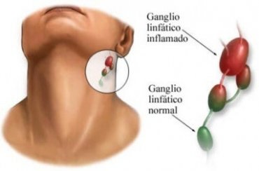 Nódulo no pescoço: tudo que você precisa saber sobre o tema