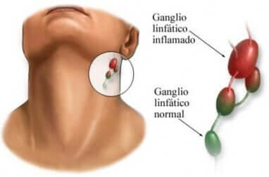 Gânglios linfáticos