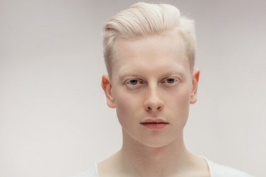 Tudo sobre o albinismo