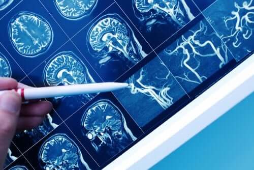 Demência vascular: tudo que você precisa saber