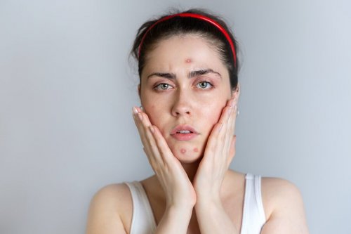 Jovem com acne durante o período menstrual