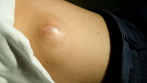 Lipoma no abdômen