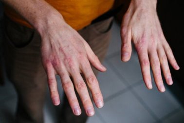 Mãos rachadas pelo frio: como tratá-las?