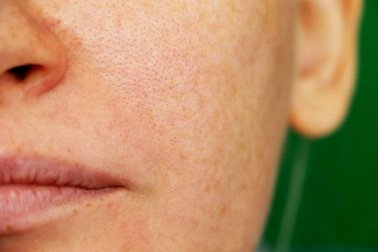 3 remédios naturais para o melasma