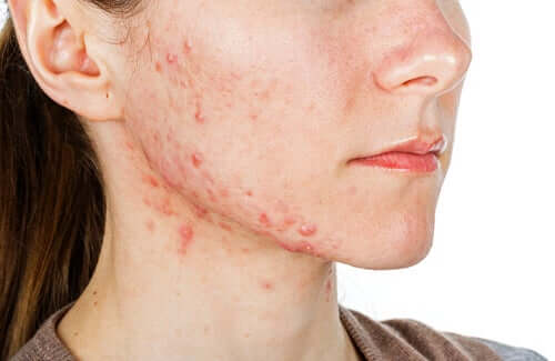 Isoface para tratar a acne grave